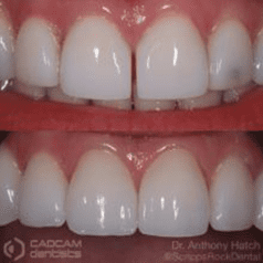 Before and after pictures of a gap tooth