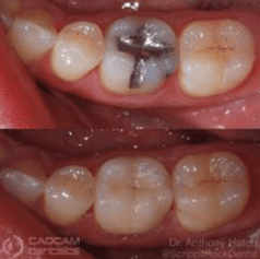 Before and after pictures of filling a cross-like indent on a molar tooth