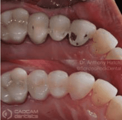 Before and after pictures of filling holes on teeth