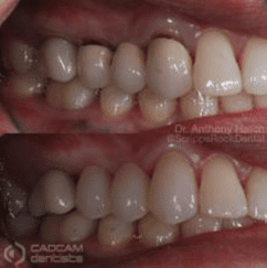 Before and after pictures fixing teeth problems near the gums