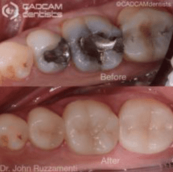 Before and after pictures of filling holes on two molars