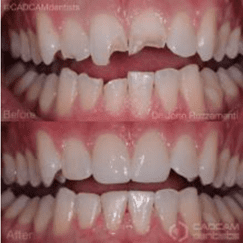 Before and after pictures of fixing chipped front teeth